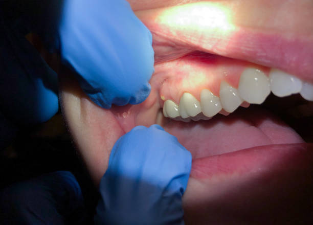 Best Emergency Denture Repair in Viola, IL